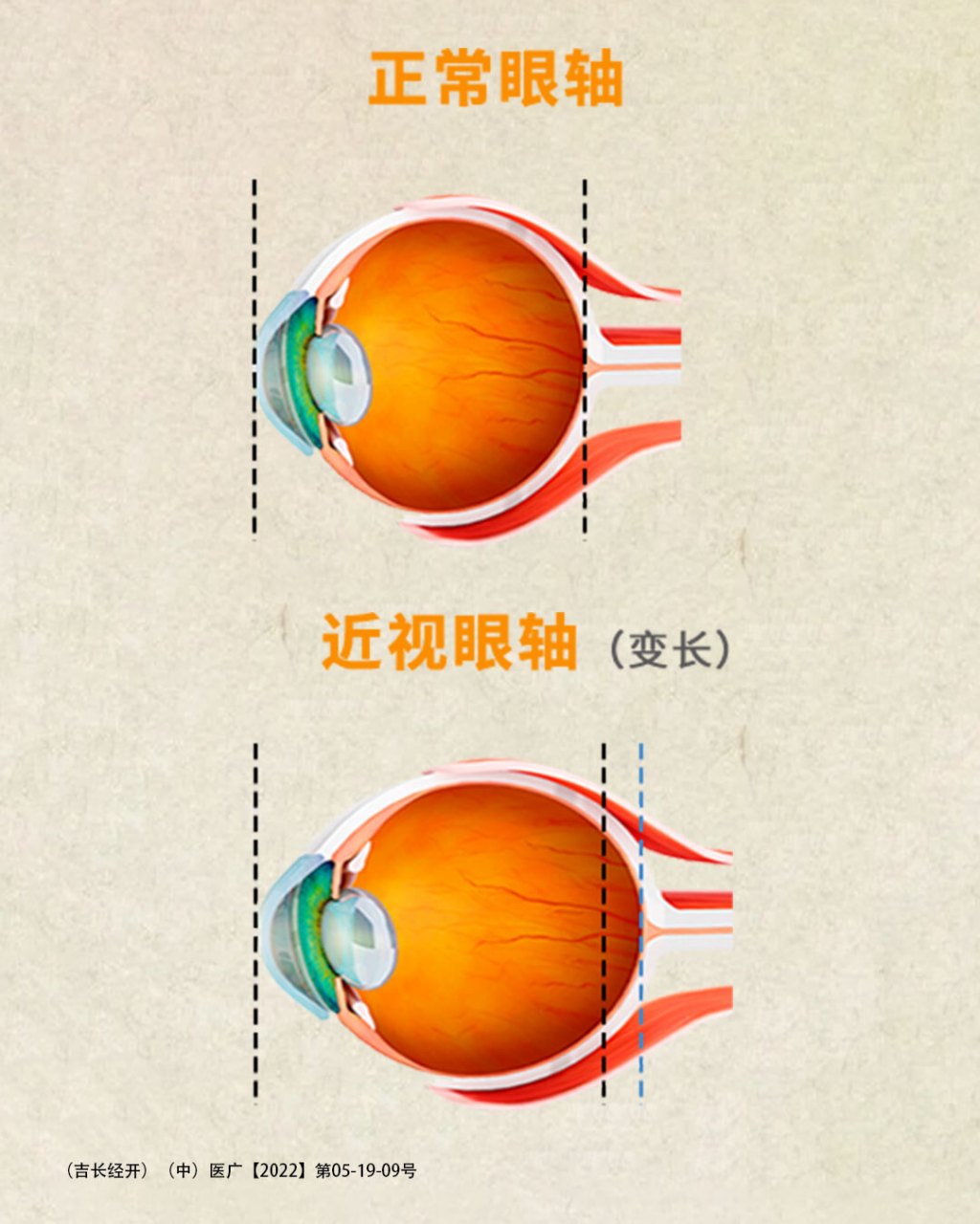 眼镜戴久了,眼睛真的会变形? 近视是一种怎样的体验?