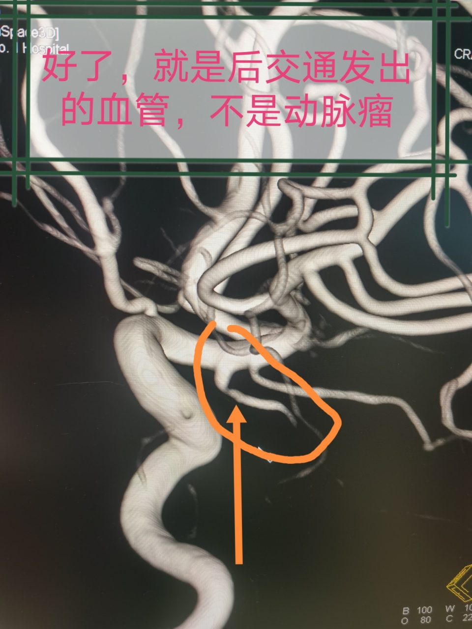 cta排查颅内动脉瘤的局限,dsa才是金标准!