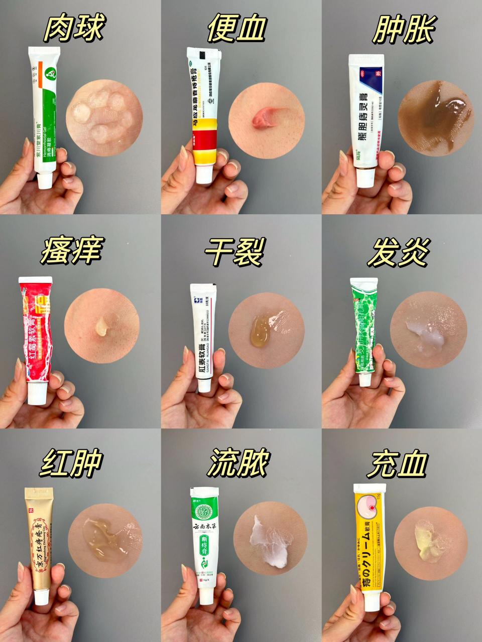 之前也是被痔疮折磨的不行瘙痒肿胀,肛周脓肿,便后出血,疙瘩疼痛统统