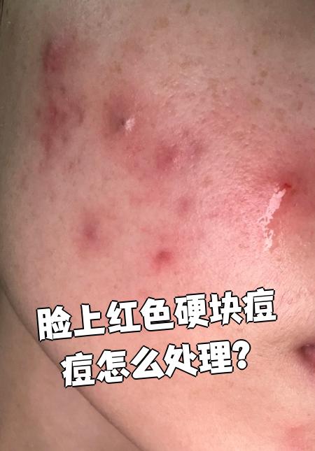 脸上红色硬块痘痘需要根据具体情况选择治疗方法