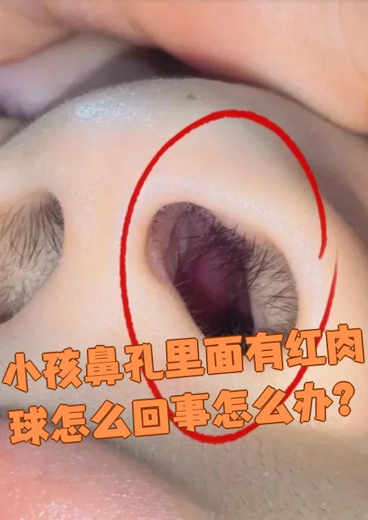 孩子鼻孔里出现红肉球可能和鼻炎,鼻窦炎,鼻息肉,鼻腔异物或鼻咽癌