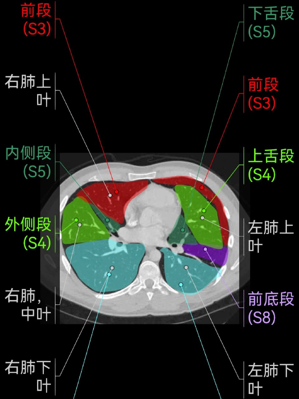 肺的ct分段(高清)|影像学习app 复习基础知识 	 右肺 上叶:s1:尖段;s2