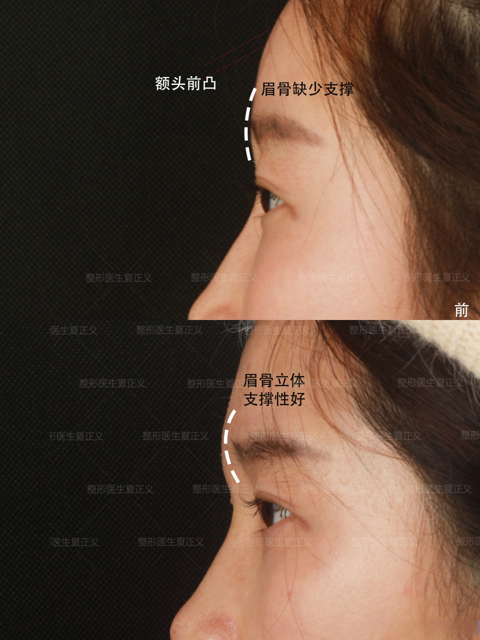 过于前凸的额头会让人看起来像寿星公,这个时候我们让眉弓变得立体