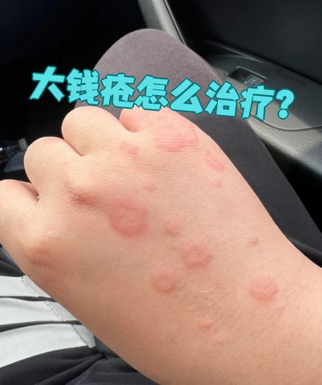 的治疗方法包括一般治疗,西药治疗和中医治疗