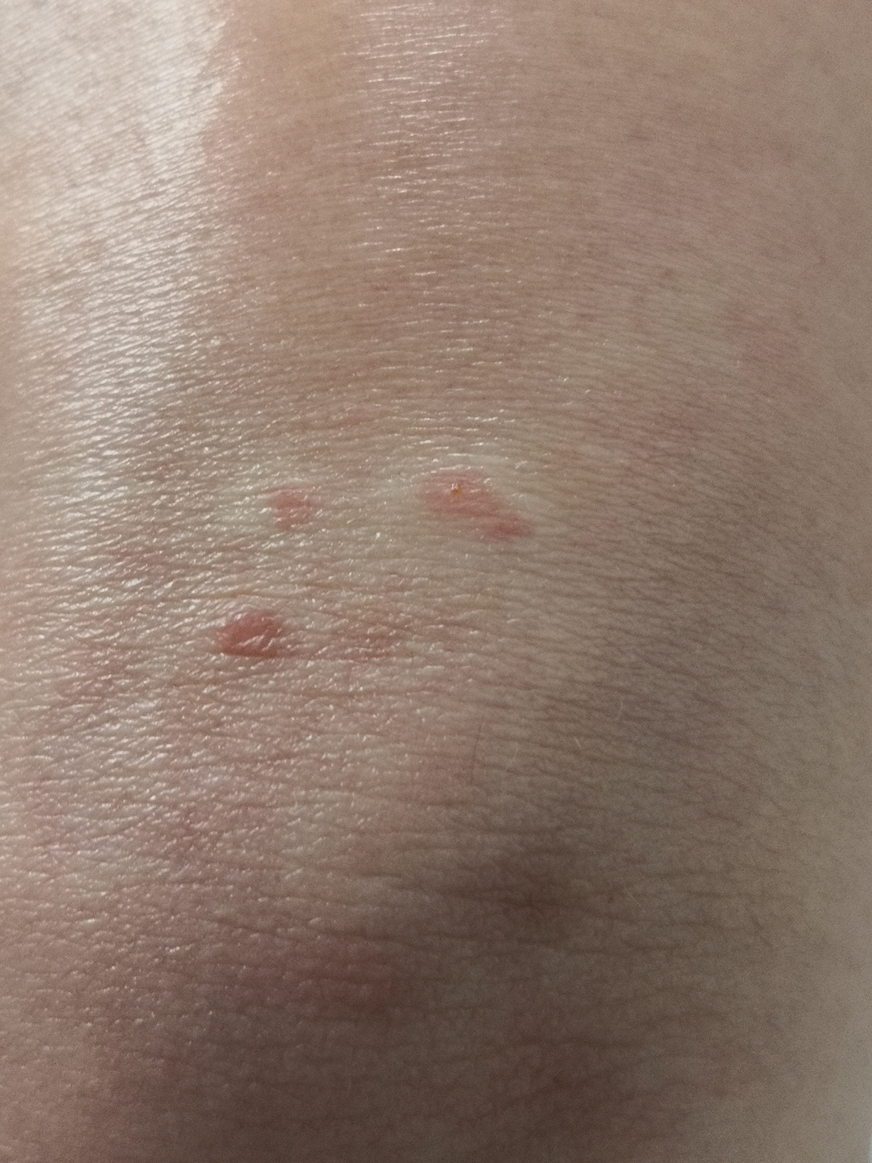 考虑真菌感染引起的体癣症状.真菌镜检阳性.