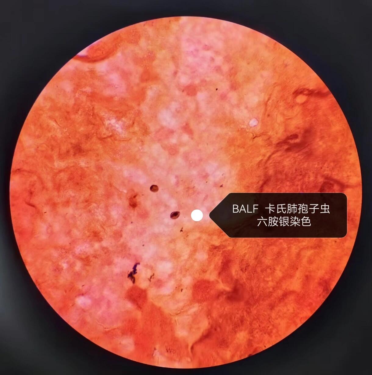 卡氏肺孢子虫(六胺银染色) 卡氏肺孢子虫(pneucystis carinii delanoe