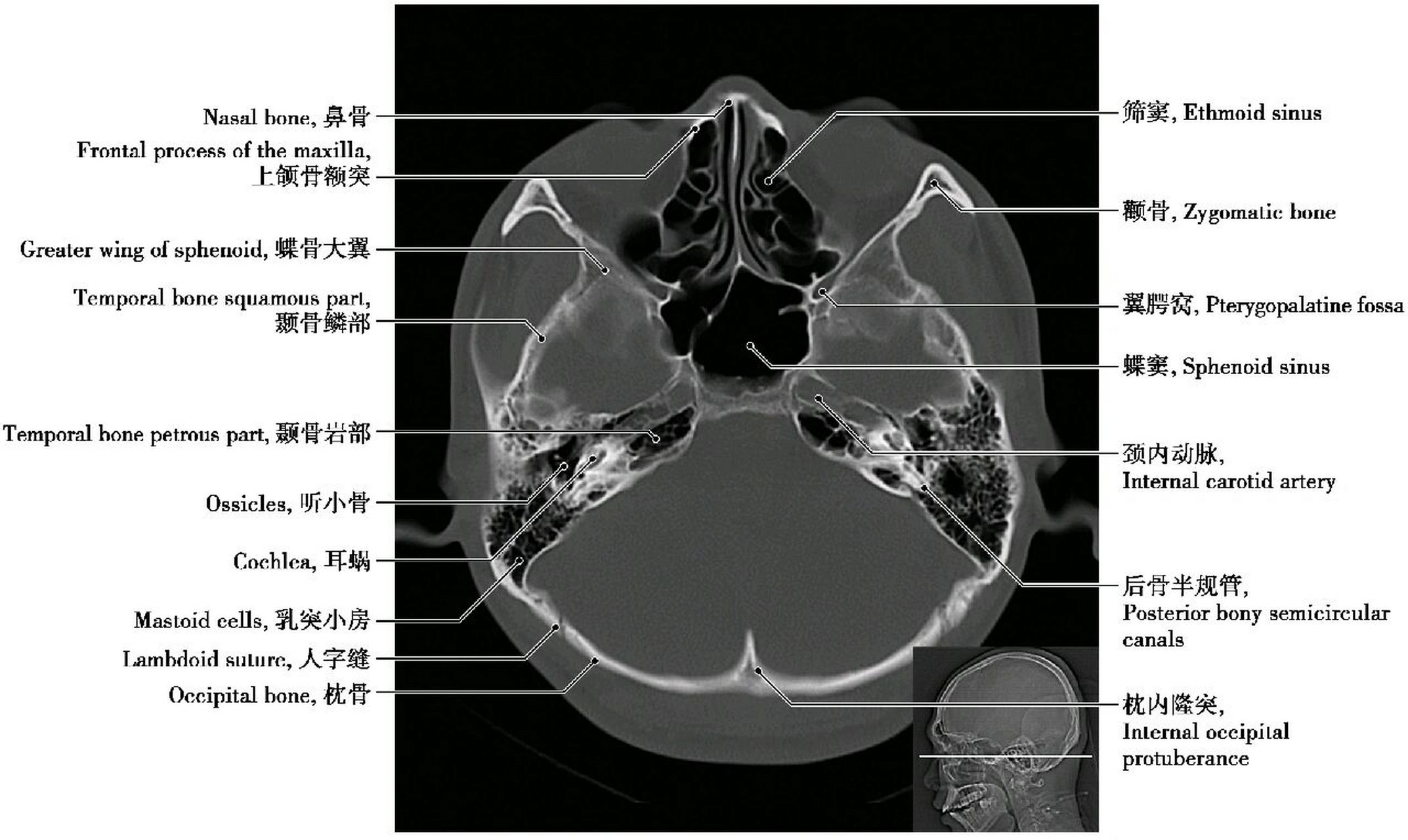 颅骨解剖图ct图片