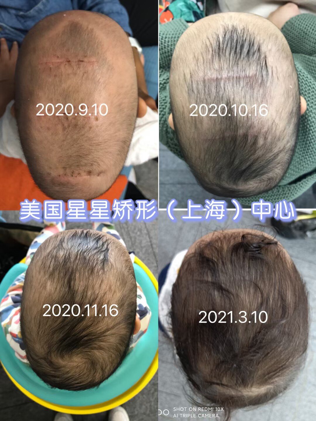 【案例分享】 矢状缝早闭,三个多月做的手术,共佩戴6个月,肉眼可见