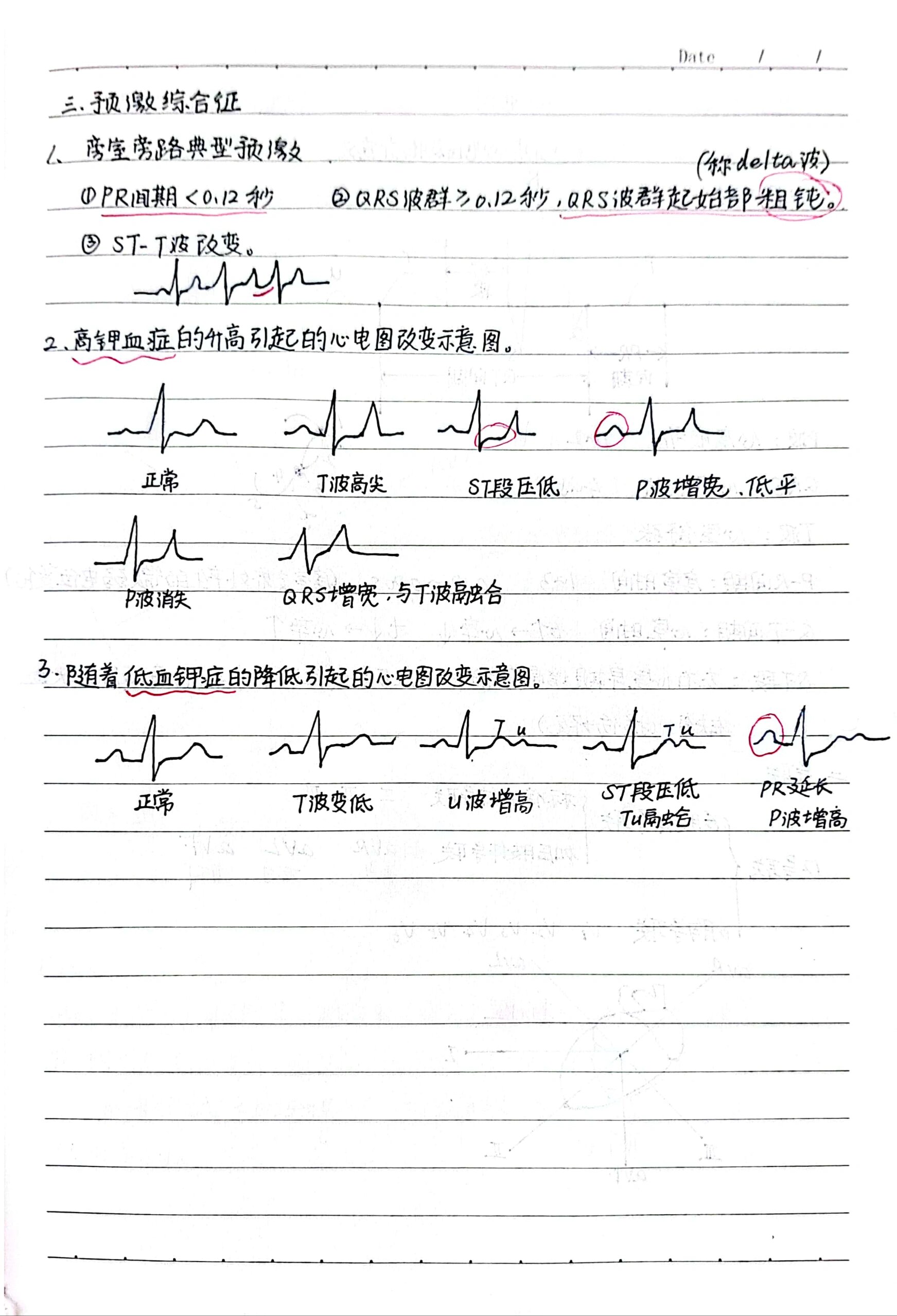 诊断学—心电图(常见异常心电图及临床意) 早博,心动过速,房室传导