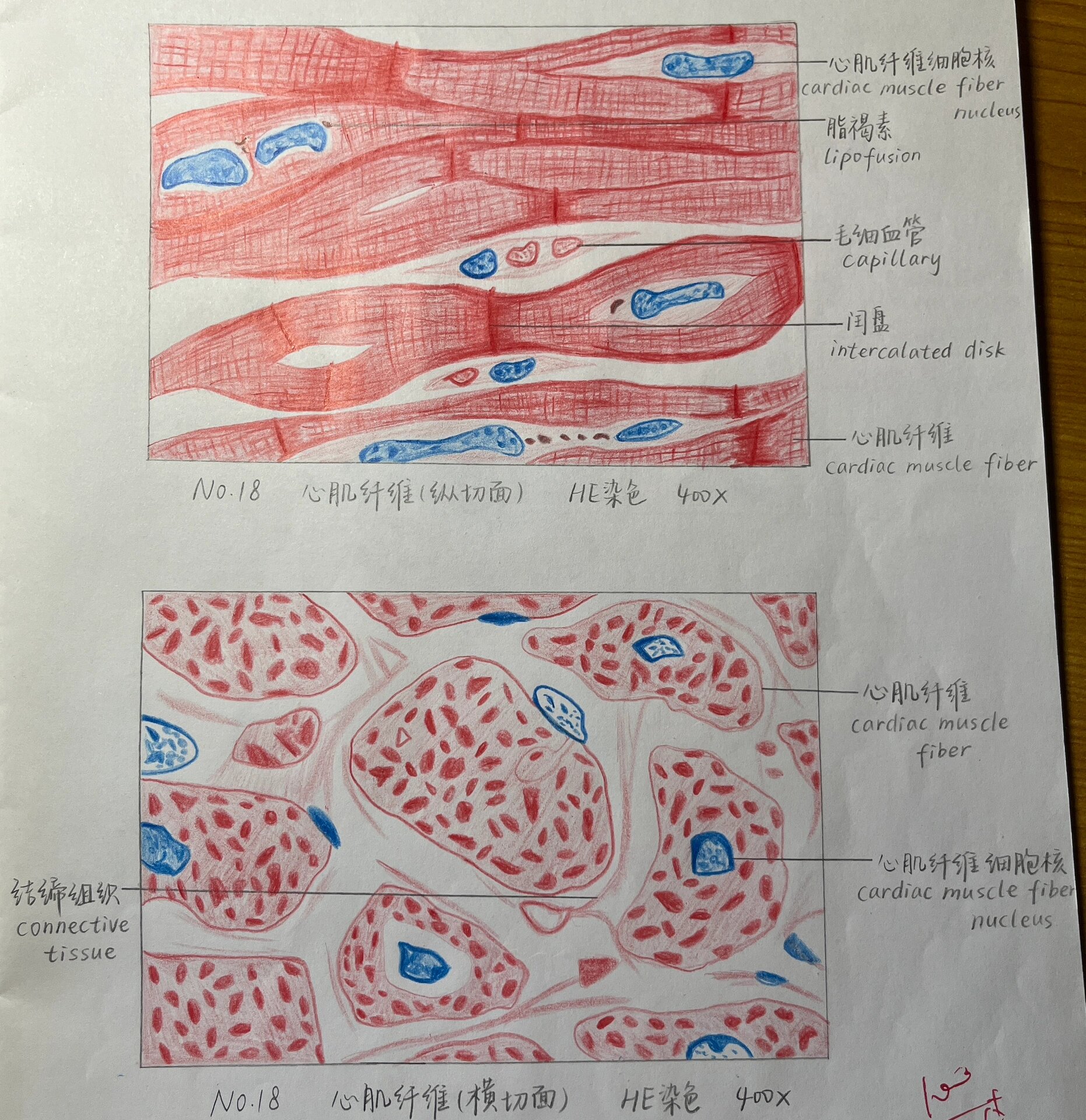 葡萄胎红蓝铅笔图图片