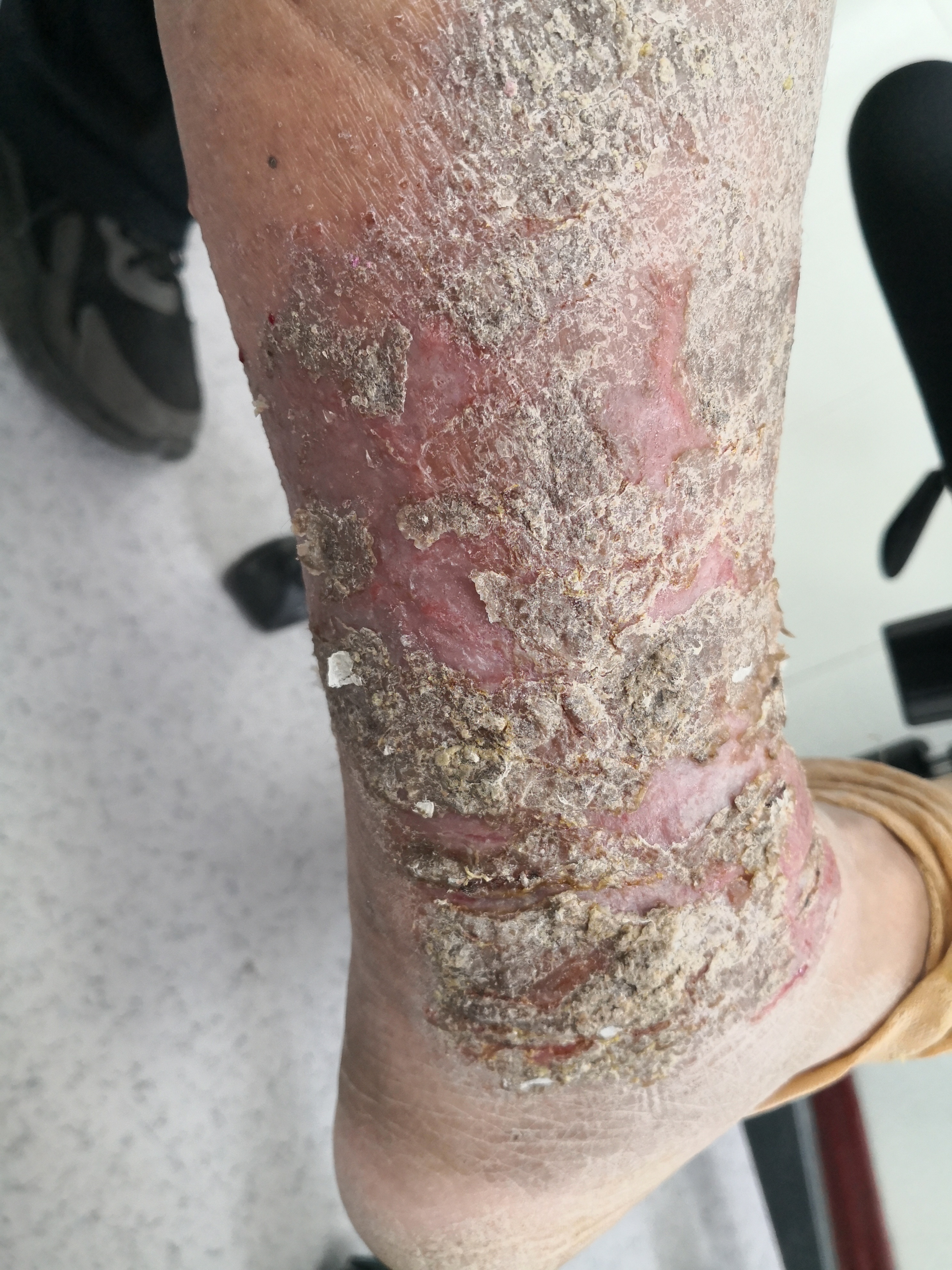 小腿部位出现肿胀红斑渗液.#湿疹##皮肤感染