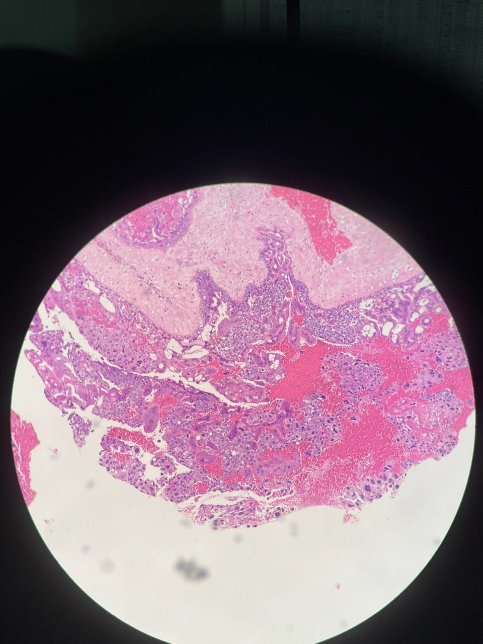 葡萄胎 1-3不完全性葡萄胎 4,5完全性葡萄胎 6正常绒毛