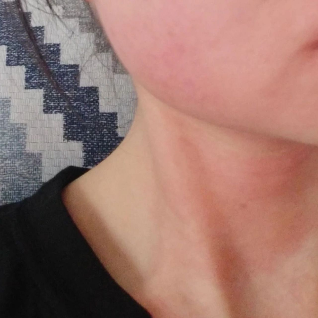 伤晒霜过敏~避坑参考 试着搜了一下防晒霜过敏,发现过敏的姐妹还挺多