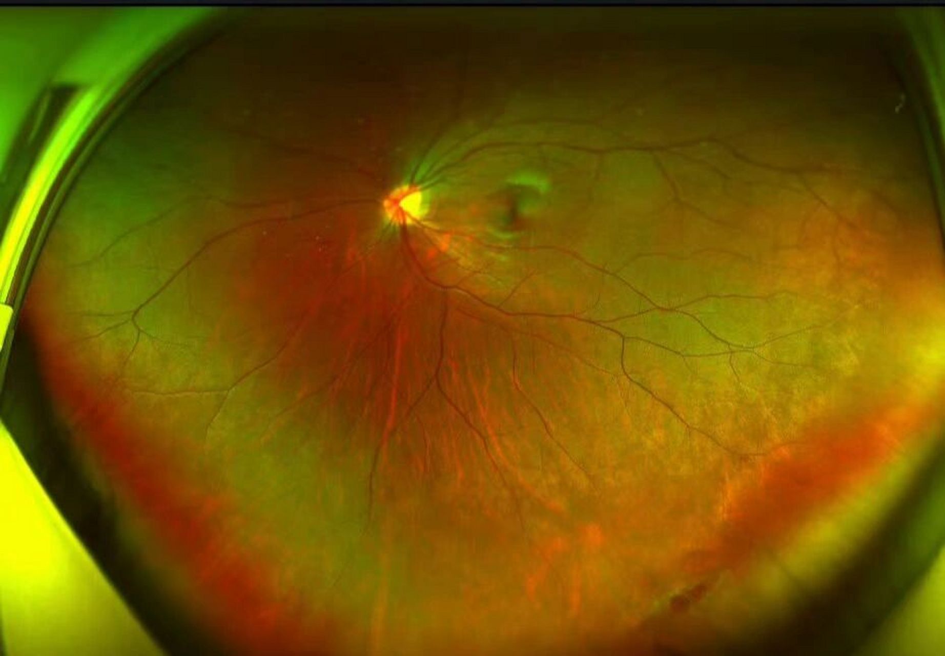 (图为眼底照) 低度近视人群也是会有视网膜裂孔问题的,视网膜裂孔并不