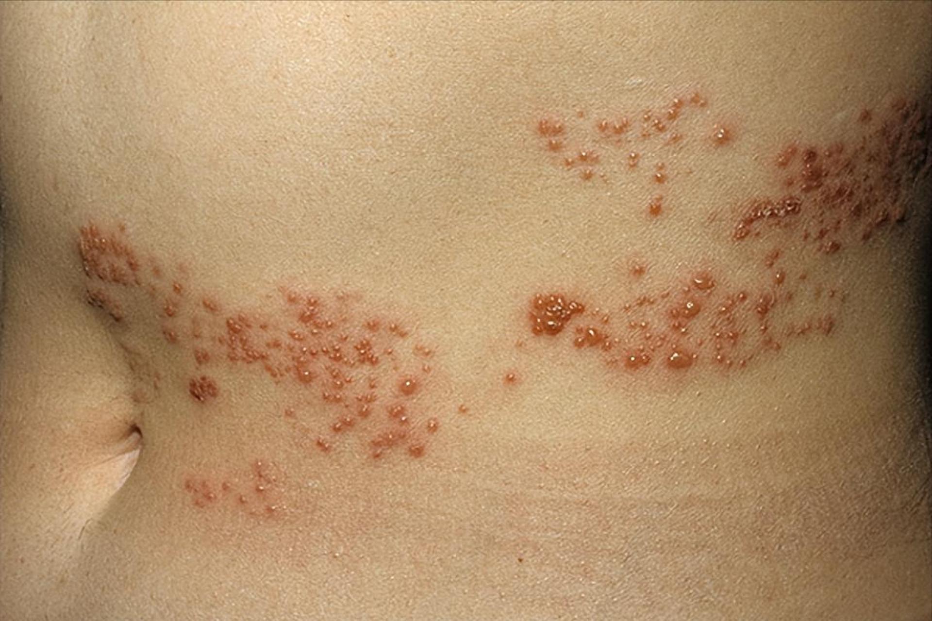 腰背部长一片红斑小水泡是怎么回事?如何正确改善带状疱疹