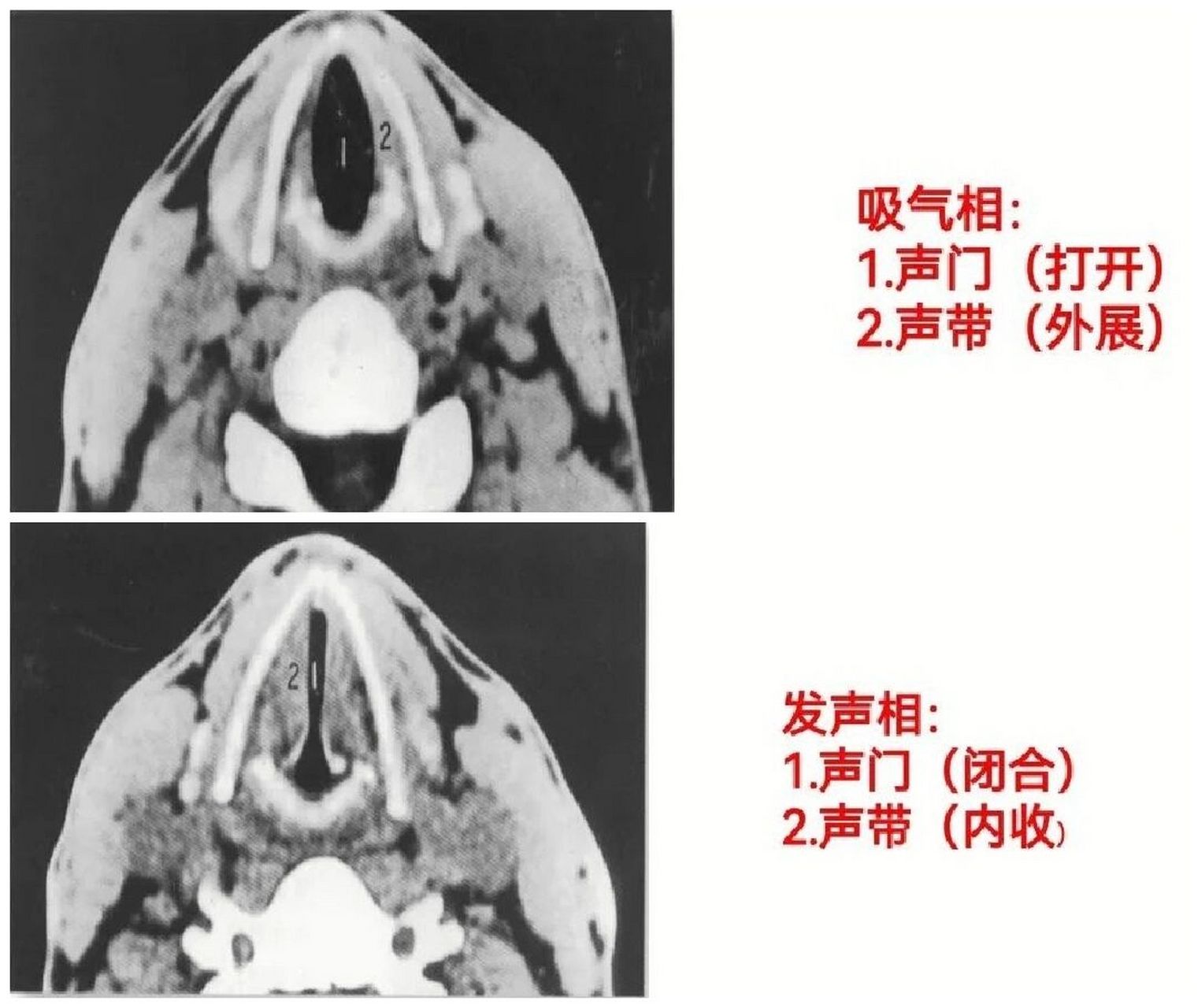 声门CT图片