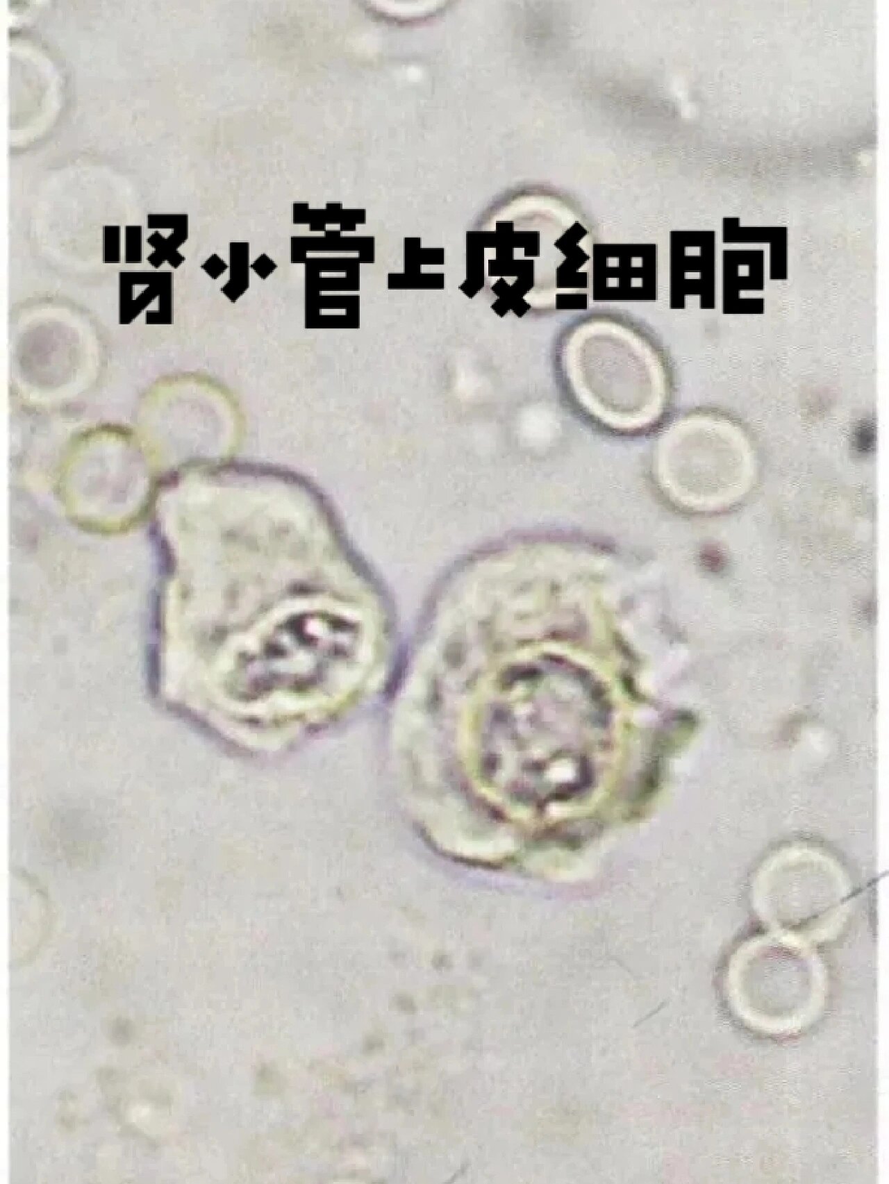 92 肾小管上皮细胞在尿中容易变形,形态往往不规则,常为圆形或