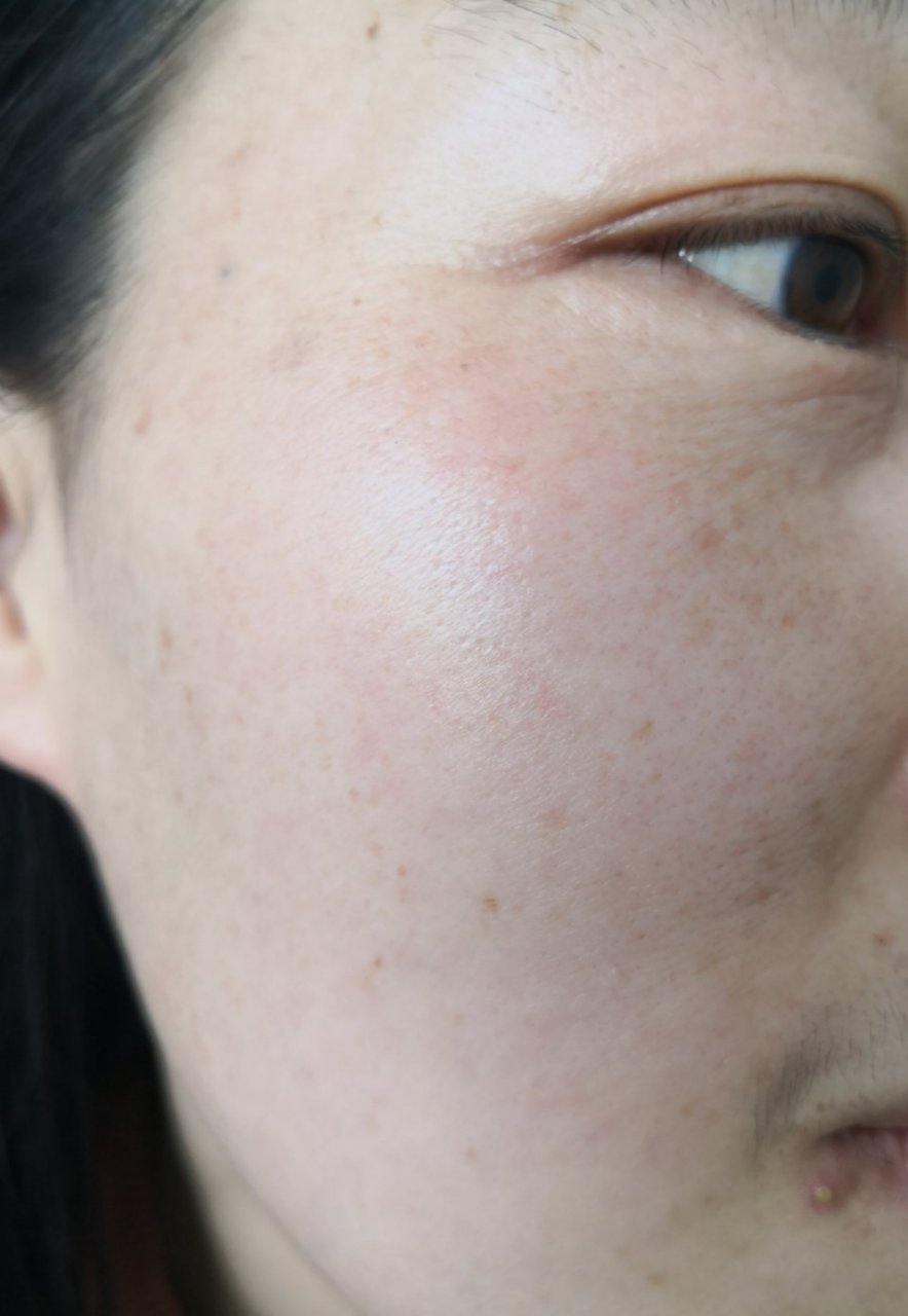 面部潮红干燥脱屑.考虑接触性皮炎症状.停用护肤品.注意防晒保湿.