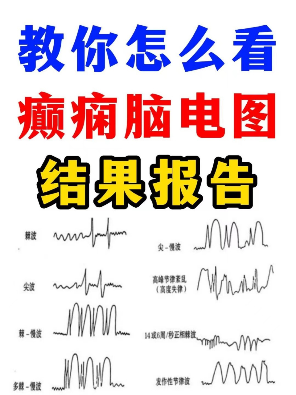 疯牛病的三相波脑电图图片