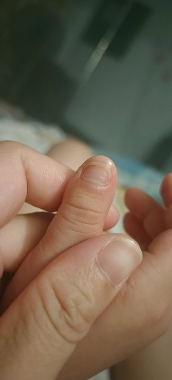 三岁小孩,几个指甲都出现分层,请问宝妈们知道什么原因吗?