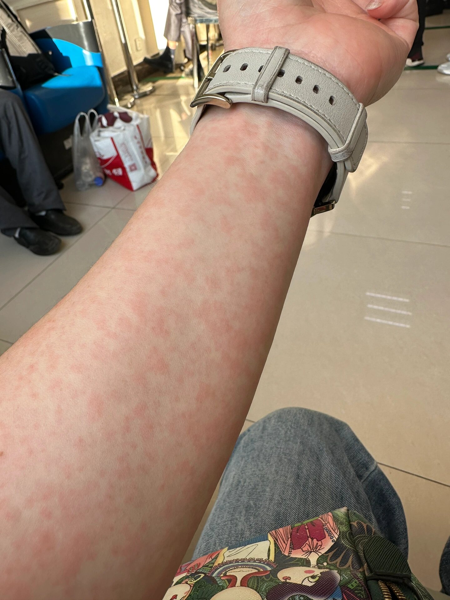 药疹   布洛芬过敏?