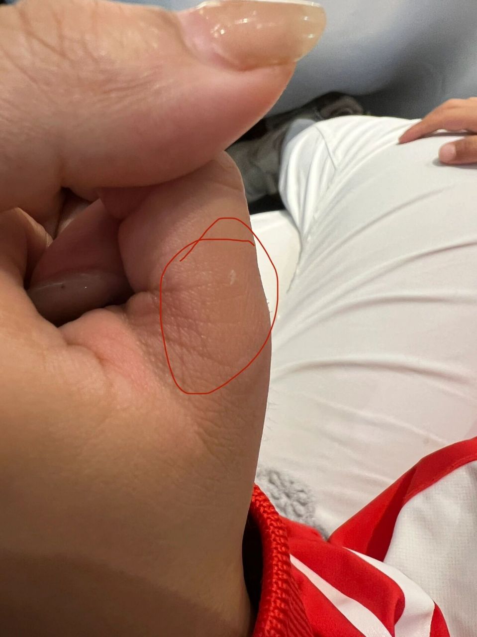 被狗咬了一口-破了点皮-需要打狂犬疫苗吗?