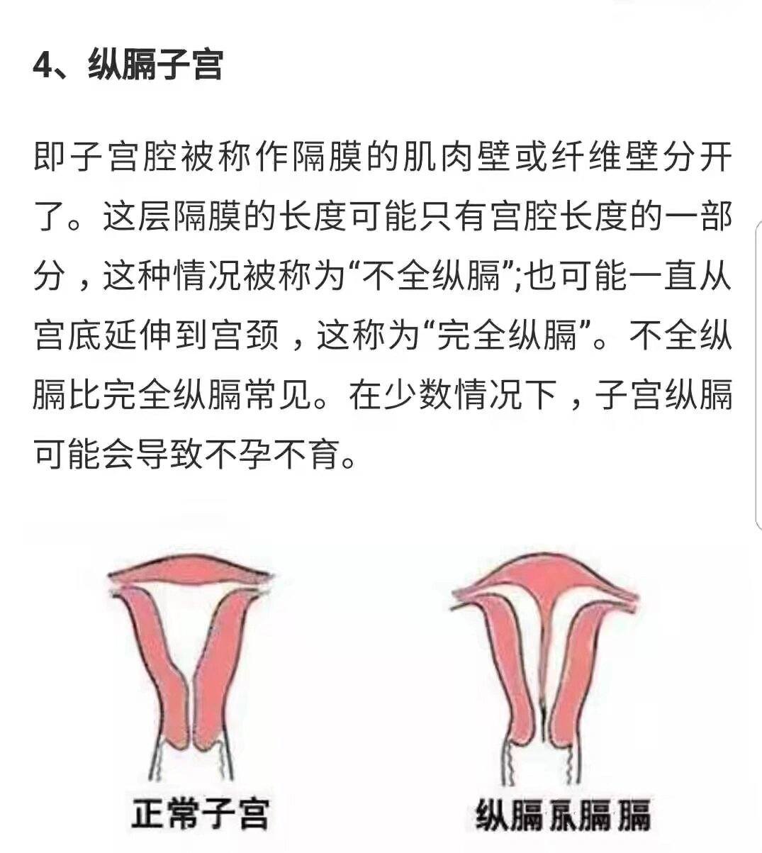 完全纵隔子宫,听劝