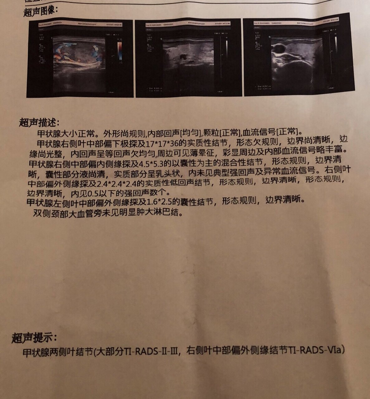 甲状腺结节 之前检查 超声描述: 甲状腺大小正常