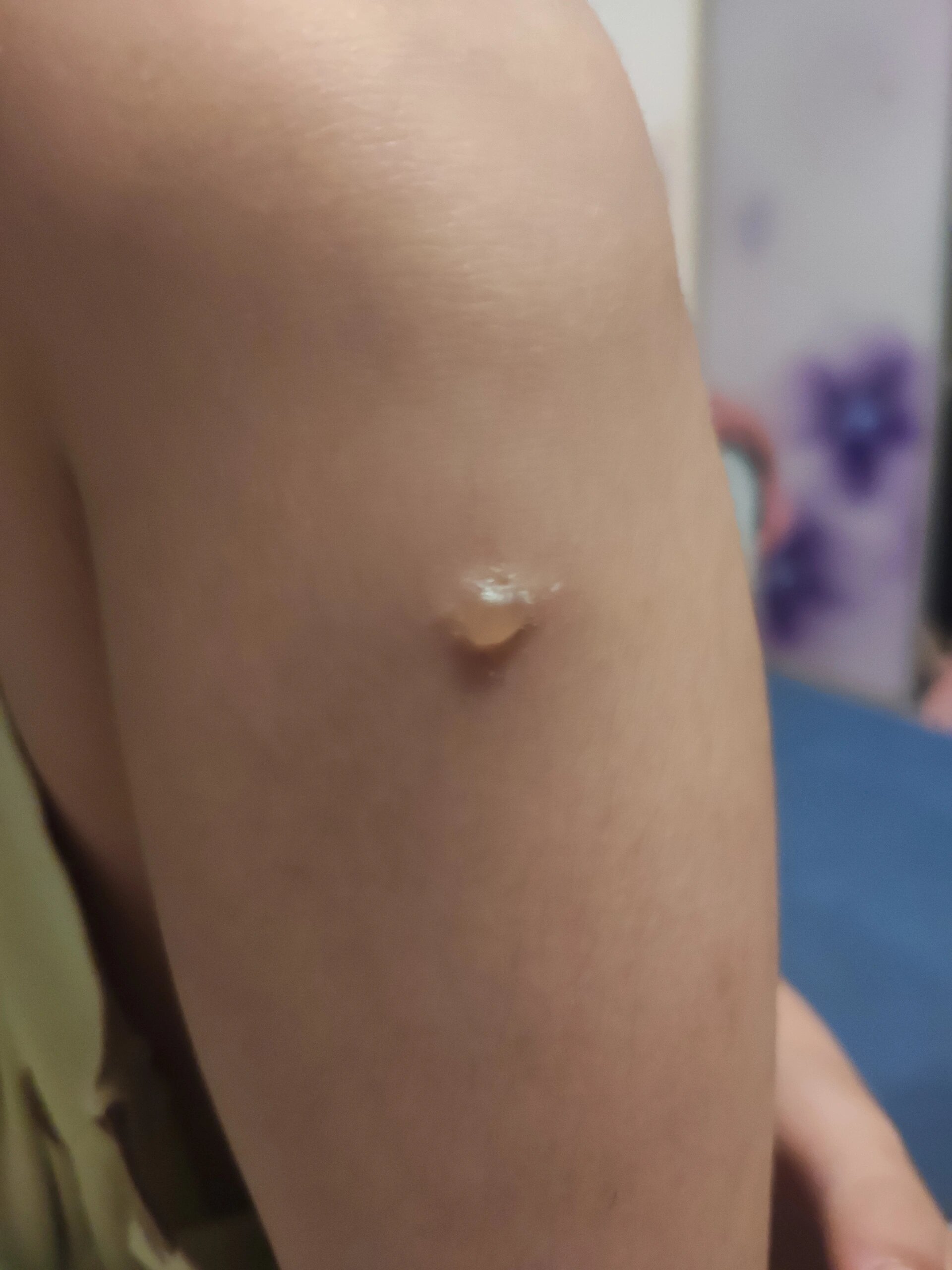 宝宝腿上长水泡