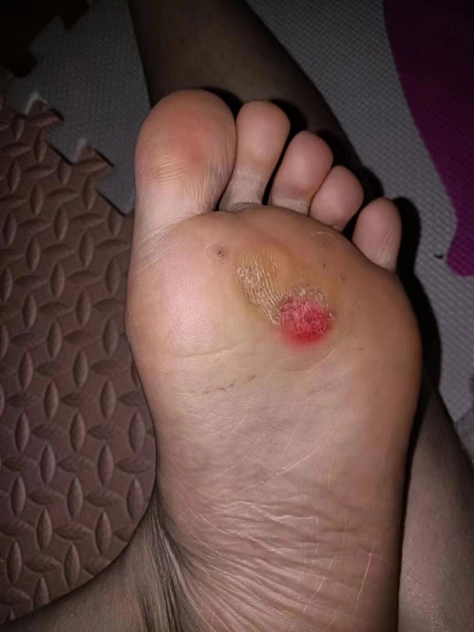 超级好用的跖疣根除方法 73间隔了三个月才来反馈的 初次脱落后可以