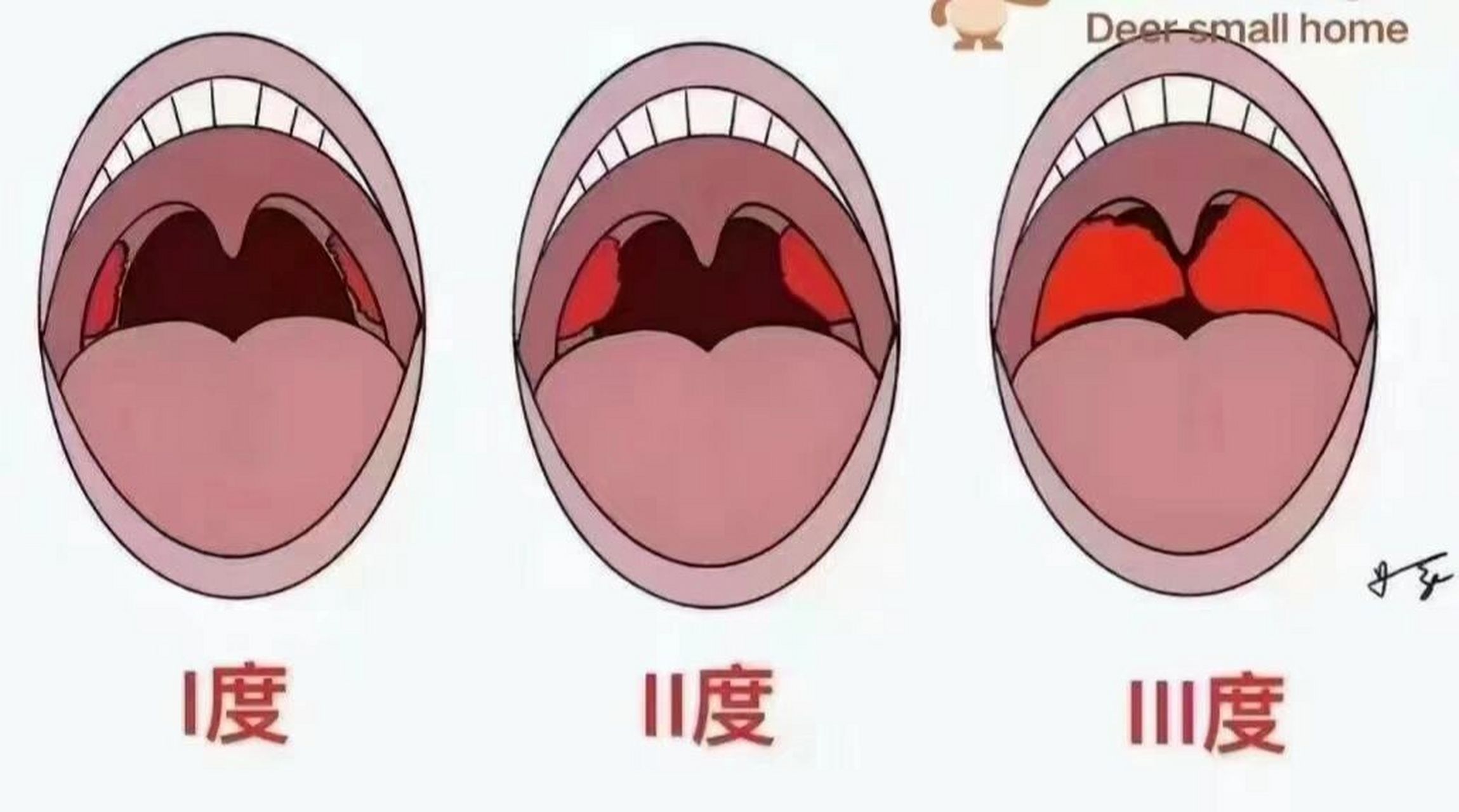 分享扁桃体肿大程度辨别知识 92早安96分享 92今天带大家认识一