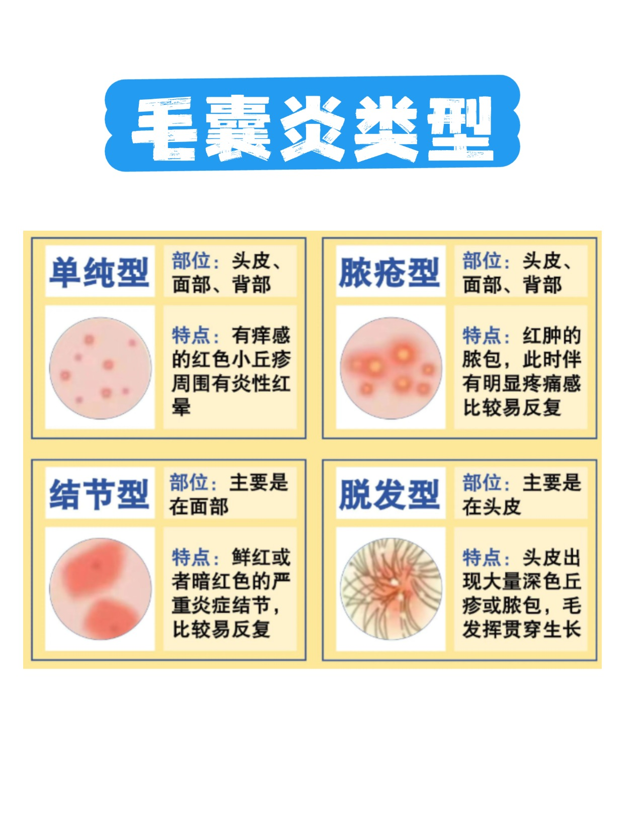 外阴毛囊炎是皮肤毛囊发炎了.它会让皮肤不舒服,影响生活