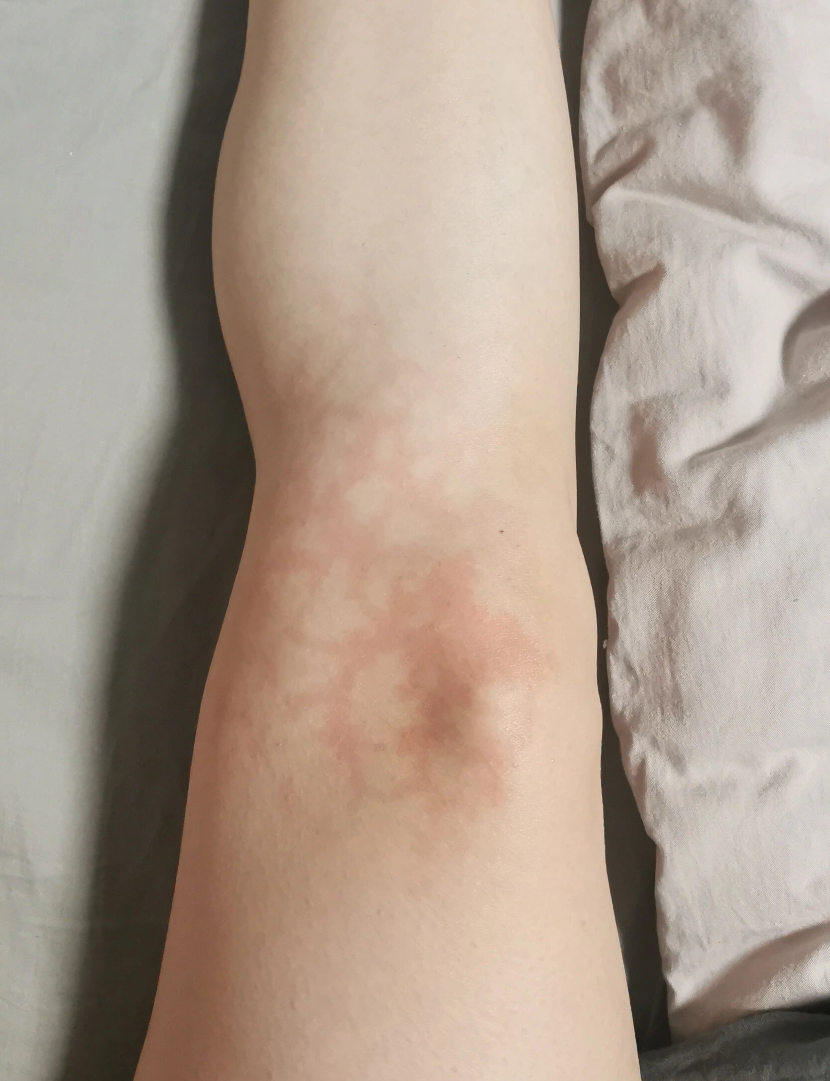 皮肤出现蜘蛛纹 为啥用理疗灯烤一烤皮肤就会出现这种网状红纹?