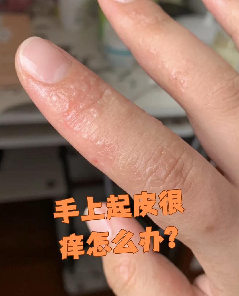 手上起皮发痒,最常见的原因是手部湿疹或者手部真菌感染