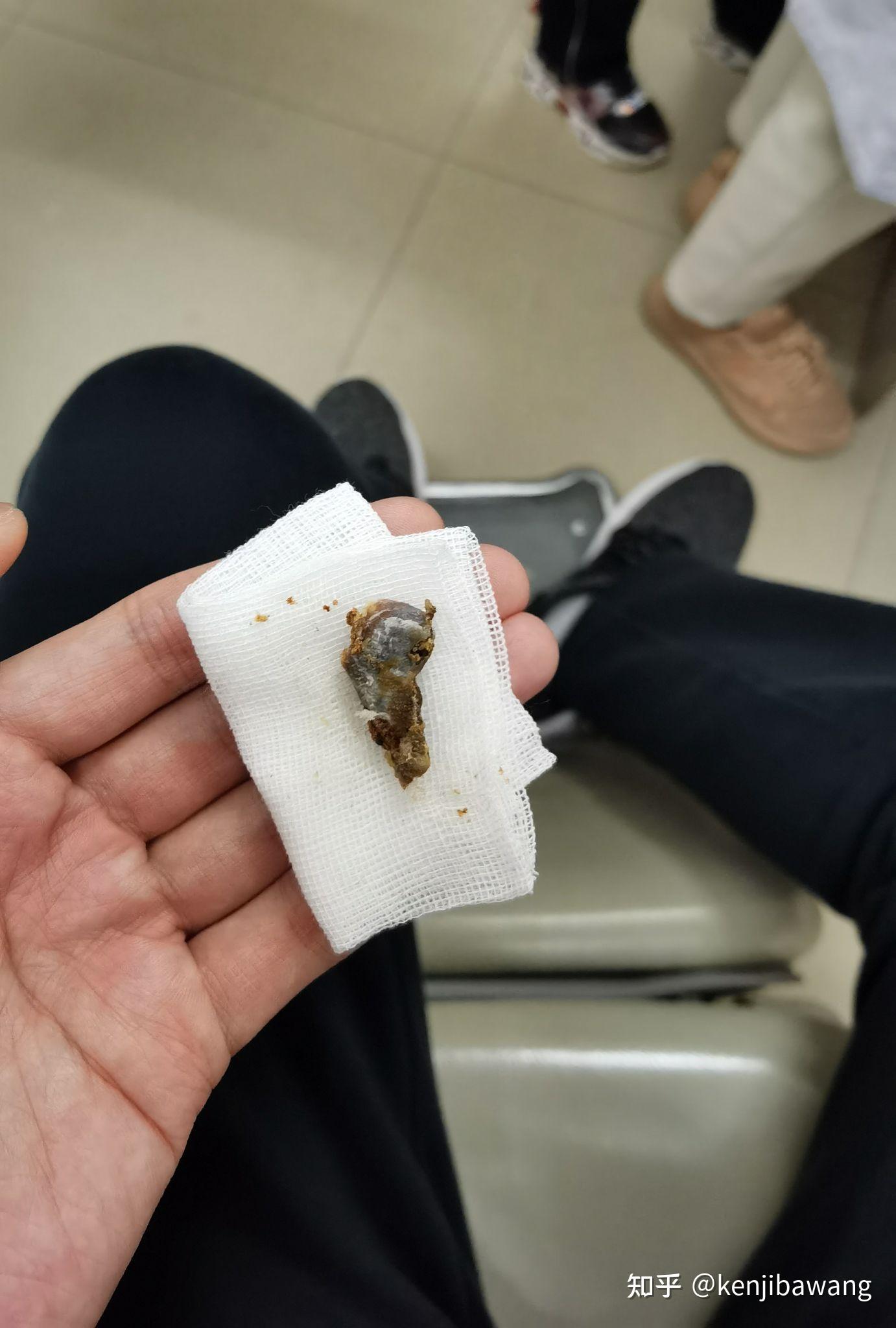 你们见过最大的耳屎有多大