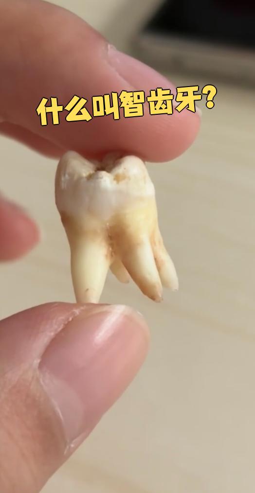 智齿也叫第三磨牙
