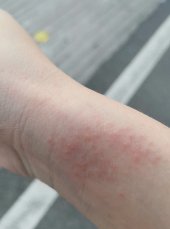 早上起来发现手臂上出现好多红点怎么回事?
