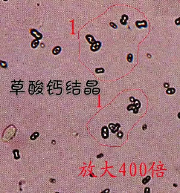 草酸钙结晶——超全高清体液图谱 →	 🍀 	 草酸钙结晶多呈无色或淡