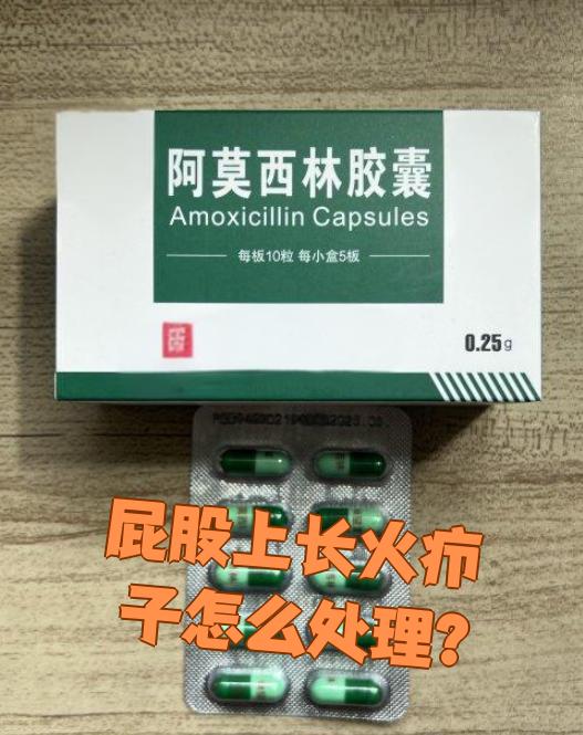 是毛囊和周围组织被细菌感染引起的