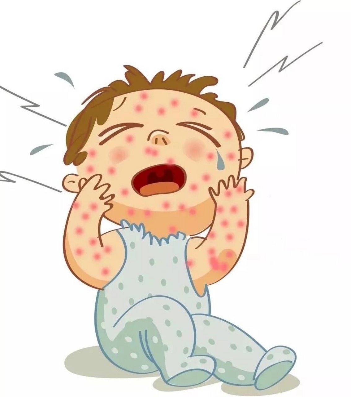 冬季水痘多发宝妈们注意了 1.