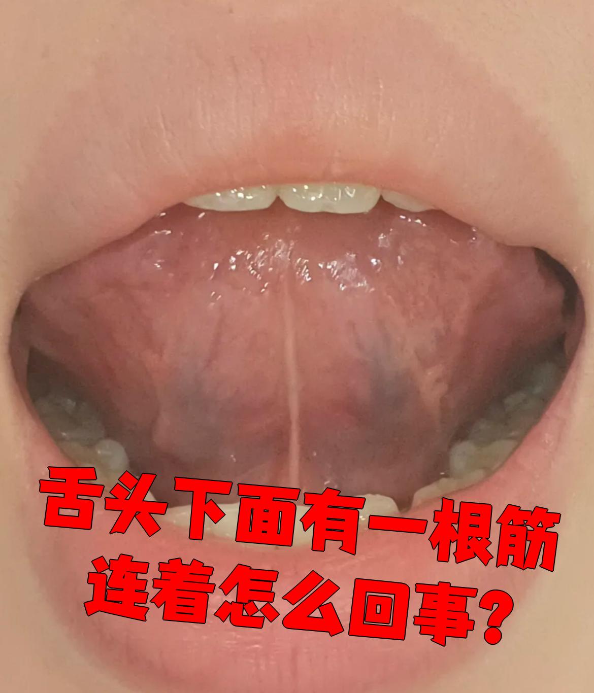 舌头下面那根筋叫舌系带这是正常的身体结构不用紧张