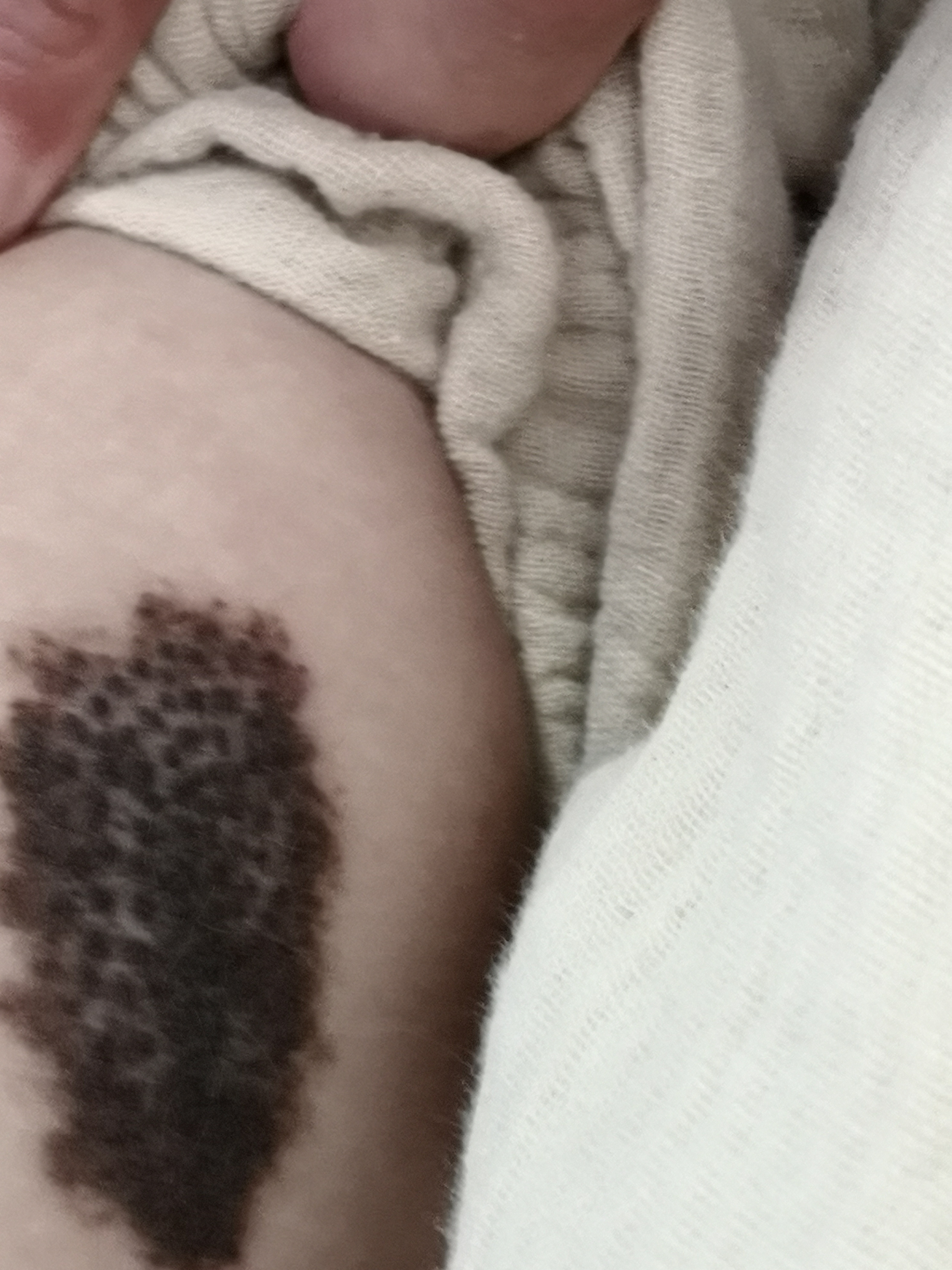 毛痣/兽皮痣.三岁以.@纪秀军皮肤科主任医师的动态