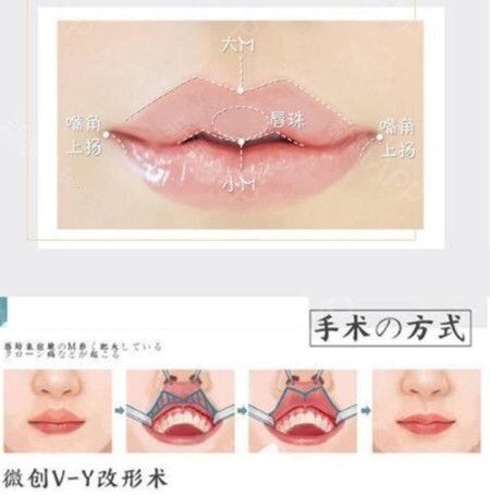 唇珠是指上唇唇红的中部部分组织向前,向下突出,像水珠一样,这个形态