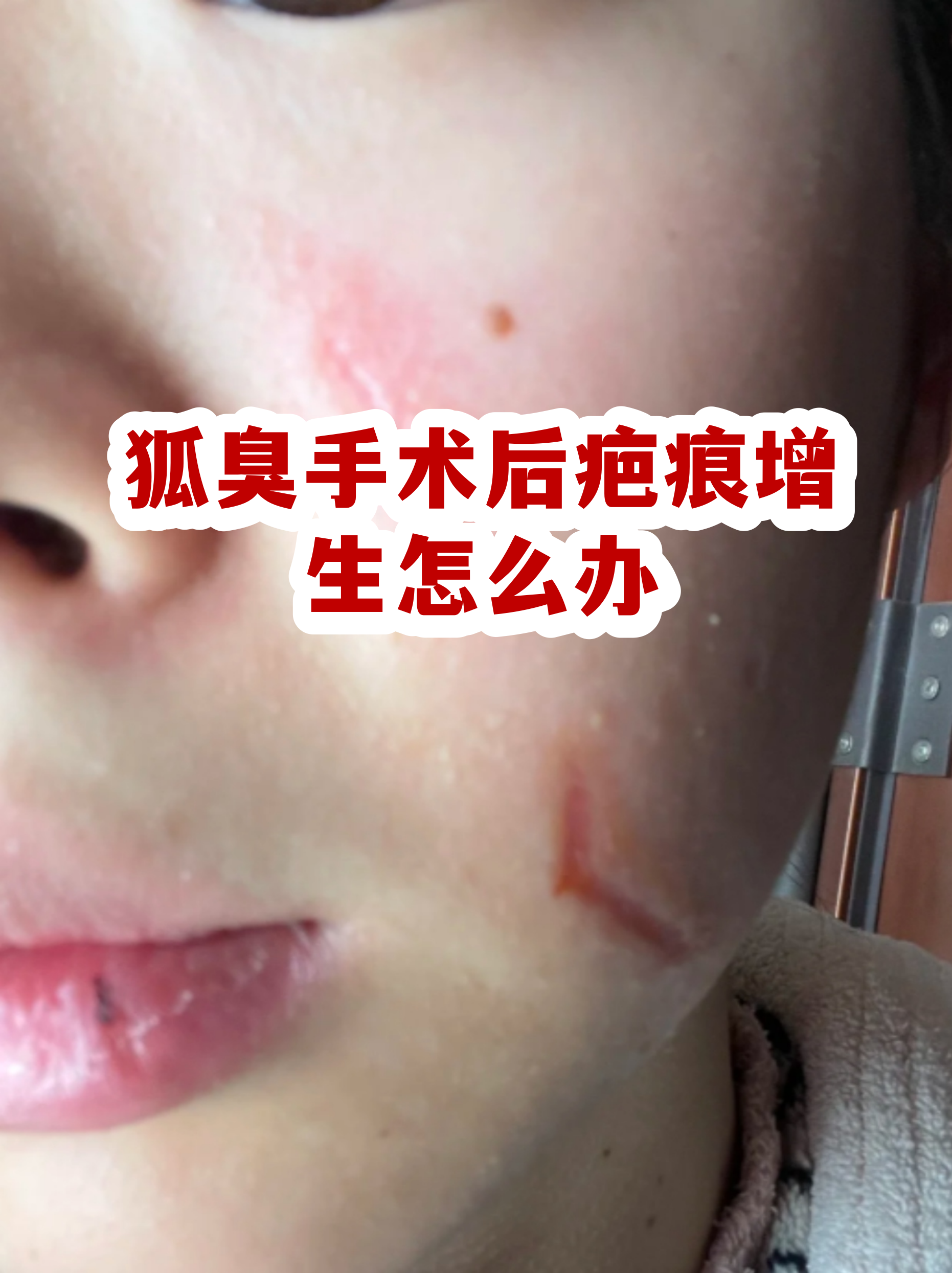 腋臭做了手术又复发了怎么办(腋臭手术做了一个月就复发了正常吗)