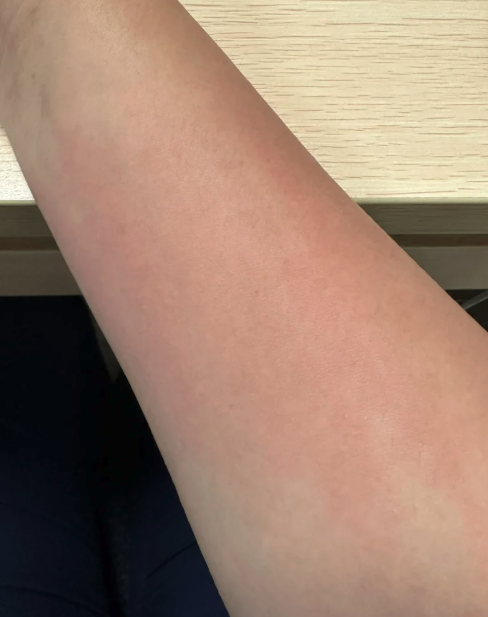 手术后如果碰到花粉,灰尘这些东西,身体会释放过敏物质,皮肤就可能