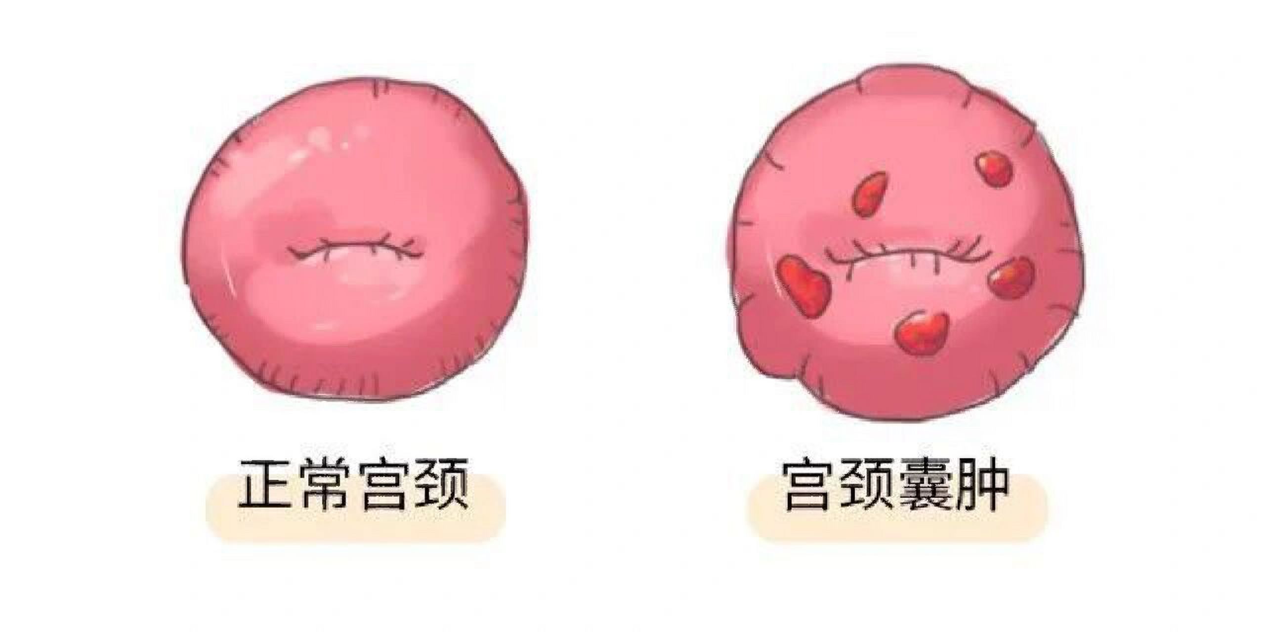 宫颈囊肿是什么?