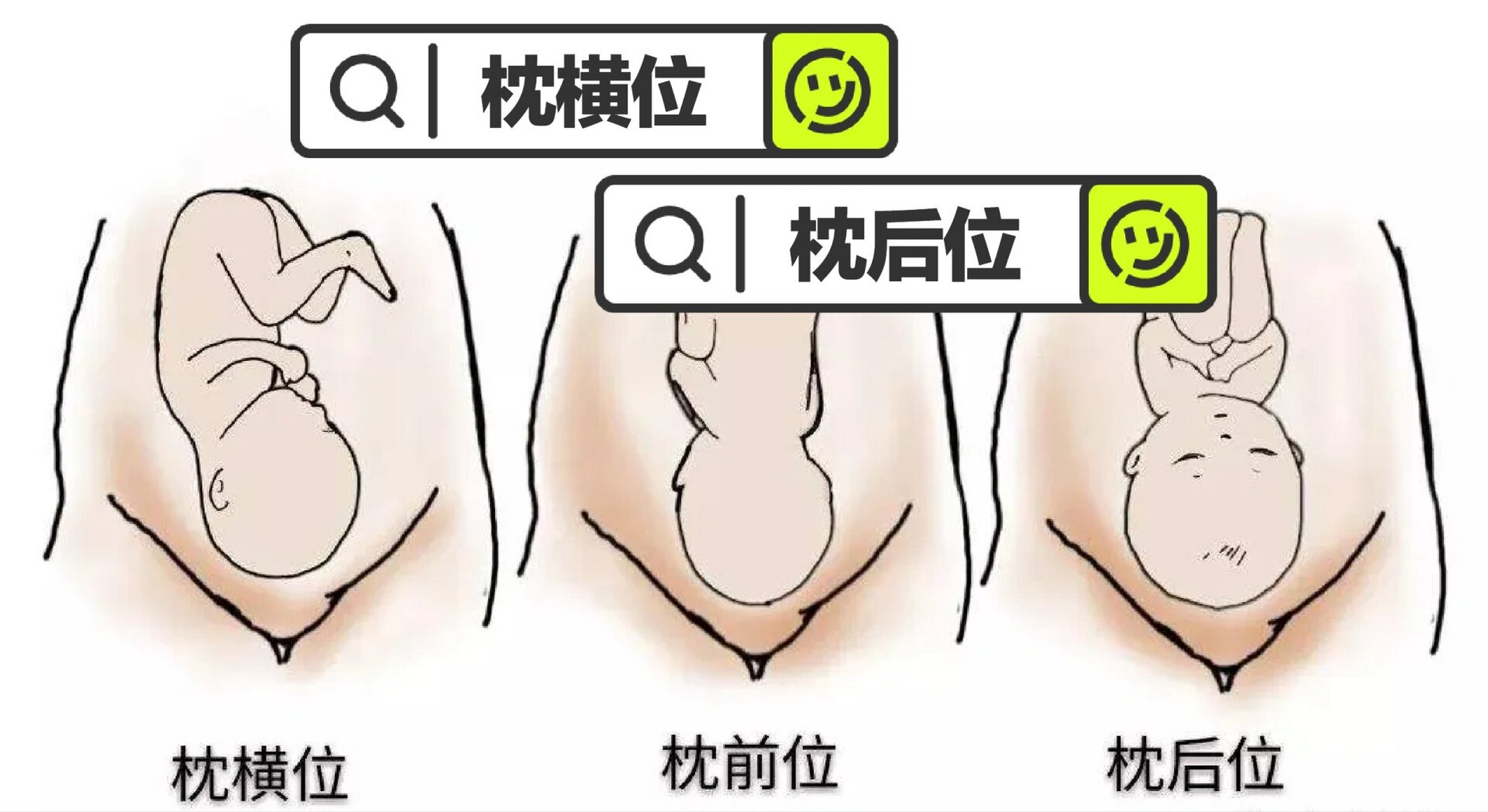 枕后位和枕横位图片图片