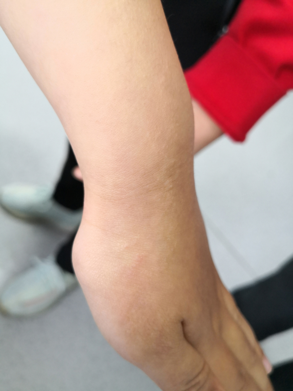 儿童腕部的线状苔藓症状