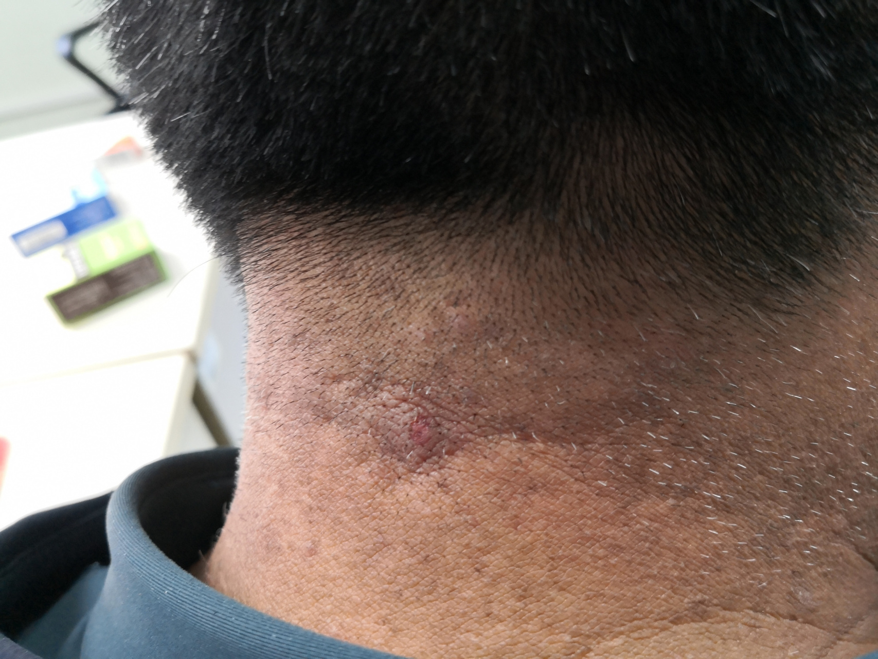 颈部毛囊炎症状和毛囊炎后疤痕.#毛囊炎##疤痕