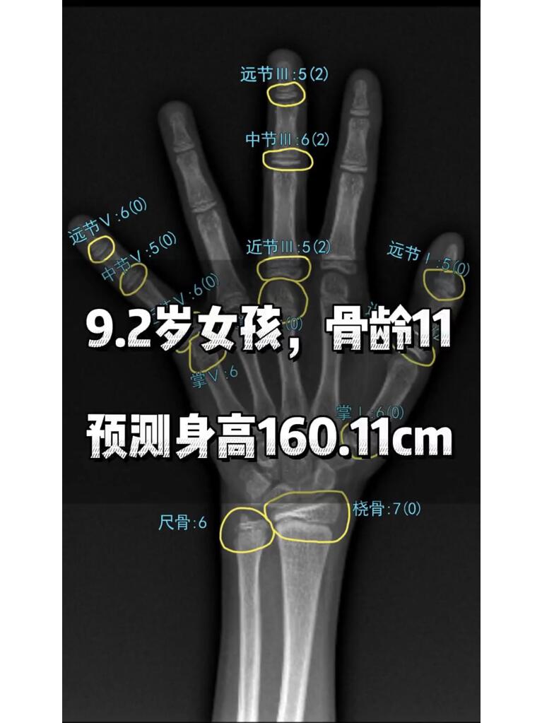 身高骨龄对照表曲线图片